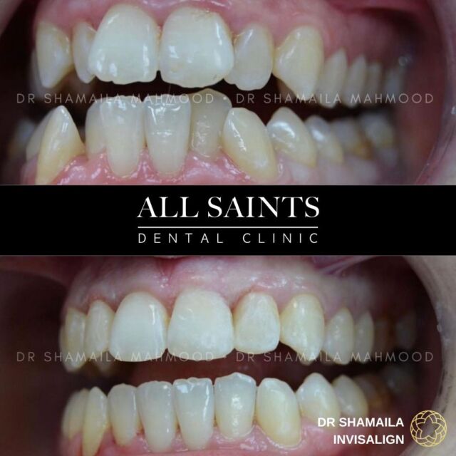 In a matter of a few months Invisalign treatment can totally transform your smile! 

More amazing results for @thetoothdoctoruk

Have you booked in for your consultation yet?

Dm us or book online today (visit the link in our bio) 📲 
⏰ Monday - Saturday
💰 0% Finance Available
📍 Kings Heath Birmingham
📧 reception@allsaintsdentalclinic.co.uk
📞 0121 444 0496
🌐 allsaintsdentalclinic.co.uk 

#birminghamuk #dentistbirmingham #braces #clearaligners #clearbraces #invisalignuk #teethstraightening #birminghamdentists #compositebonding #teeth #dermalfillers #cosmeticdentists #facialaesthetics #lipfillersbirmingham #bhambloggers #compositebonding #dentalimplants #smile #keepingbirminghamsmiling #invisalignuk #invisablebraces #happypatient #happydentist #dentistry